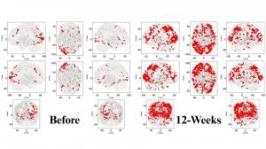 Difference in brain after using U: The Mind Company device over 12 weeks