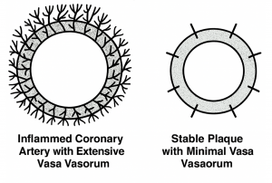 Inflamed atherosclerotic plaques have high density of vasa vasorum