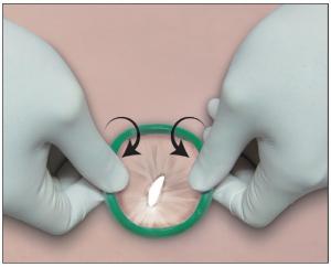 plastic wound retractor market