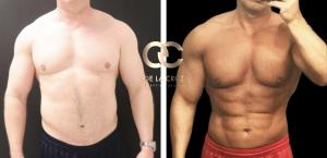 male high-definition liposuction 6 months after surgery showing abdominal definition and body contouring results