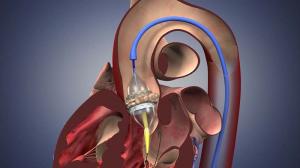 transcatheter aortic valve replacement (TAVR) market