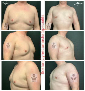 ChestSculpt Procedure by Edwin Ishoo, MD