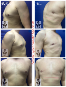 Gynecomastia Treatment Results at Boston Gynecomastia Specialists