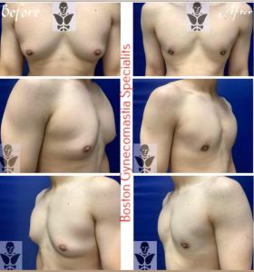 Transformative Male Breast Reduction at Boston Gynecomastia Specialists