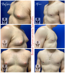 Male Breast Reduction Results at Boston Gynecomastia
