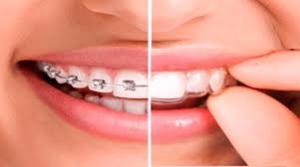 invisible orthodontics market