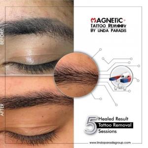 Magnetic Tattoo Removal Before After