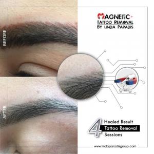 Magnetic Tattoo Removal Before After