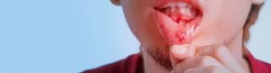 Behcet’s disease treatment market
