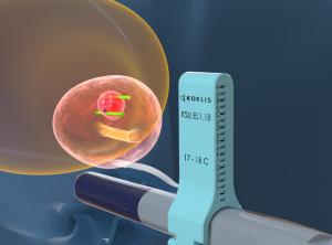tp illustration for the KOELIS trinity MRI fusion prostate ultrasound