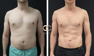 Before and after long-term high-definition liposuction results demonstrating preserved abdominal definition and smooth contour transitions by Dr. Emmanuel De La Cruz