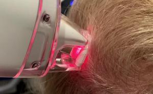 LaseMD Ultra creating microchannels in scalp