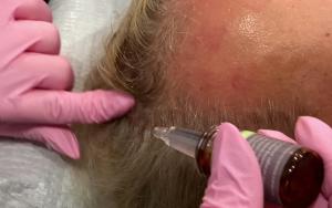 Applying KeraFactor growth factors to the scalp for hair growth