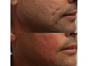 Using filler and subcision for acne scars Dr. Steven F. Weiner, MD