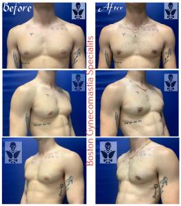 Gynecomastia Treatment Results at Boston Gynecomastia Specialists
