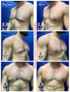 Male Breast Reduction Results at Boston Gynecomastia Specialists