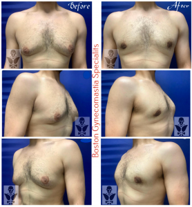 Transformative Male Breast Reduction