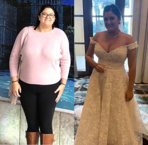 before and after image of a female patient with significant weight loss