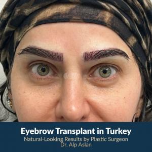 Natural-looking eyebrow transplant result performed by Plastic Surgeon Dr. Alp Aslan at Este Surgery in Istanbul, Turkey.