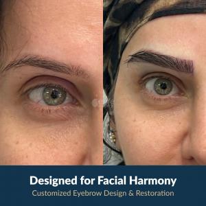 Customized eyebrow transplant design procedure at Este Surgery in Turkey.