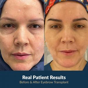 Before and after eyebrow transplant transformation performed in Turkey.