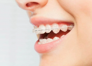 Braces and Aligner