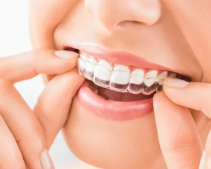 Clear Aligners