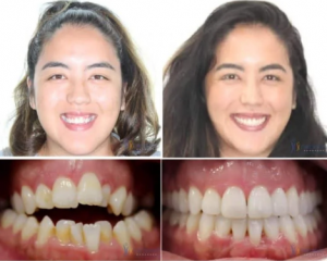 before and after treatment