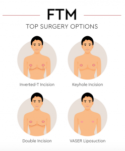 Most common approachs for FTM Top Surgry