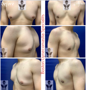 Transformative Male Breast Reduction
