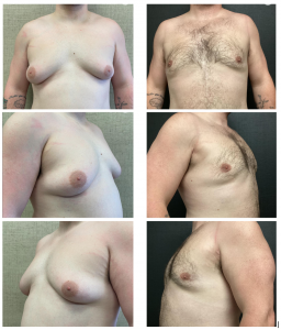 Chest Masculinization Result Performd by Dr. Edwin Ishoo, MD, FACS