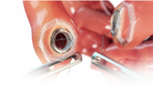 Intracorporeal Anastomosis