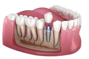 Dental Implants at Coolamon Dental Centre Ellenbrook