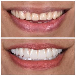 Teeth Whitening Brisbane