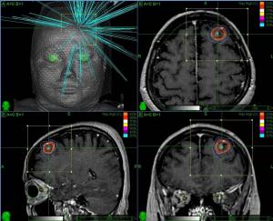 MRI-guided stereotactic radiosurgery treatment planning for a frontal convexity meningioma showing convergent radiation beams and conformal dose distribution for precise, non-invasive brain tumor treatment at Dr. Rao's Hospital.