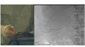 Delivery of the ULTRA Embolic Device showing the syringe in the physician's hand on the left and the fluoroscopy image on the right where the material is opaque to X-ray and clearly seen exiting the catheter in a controlled manner and filling a large, ren