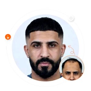 Before and after hair transplantation at Padra Clinic, Saudi Arabia Branch