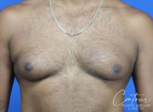 Photo of Before Gynecomastia Treatment
