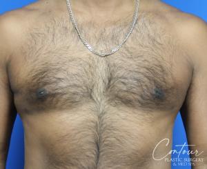 Front view three months after minimally invasive gynecomastia treatment