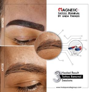 Magnetic Tattoo Removal Before After Microblading Removal