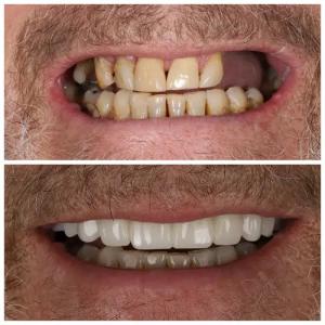 Before and after All-On-4 dental implants