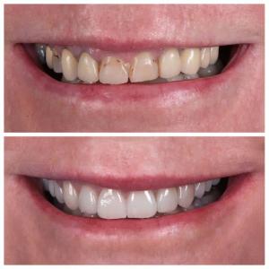 Teeth Whitening at Perth Dental Rooms