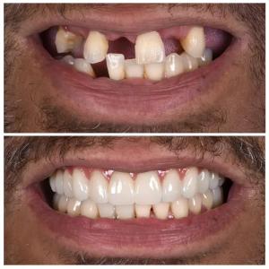 Dental Implants Treatment at Springfield Dental