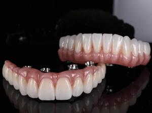All-On-4 dental implants treatment
