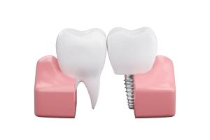 Dental implant surgery Brisbane