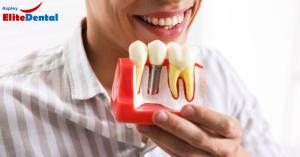 Dental implants Brisbane