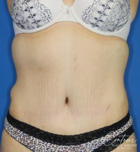Front view after a tummy tuck