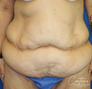 Front view before tummy tuck