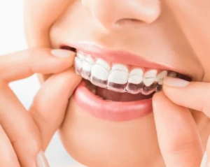 Clear Aligners in LA