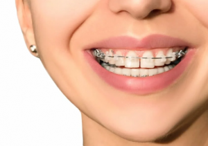 Braces